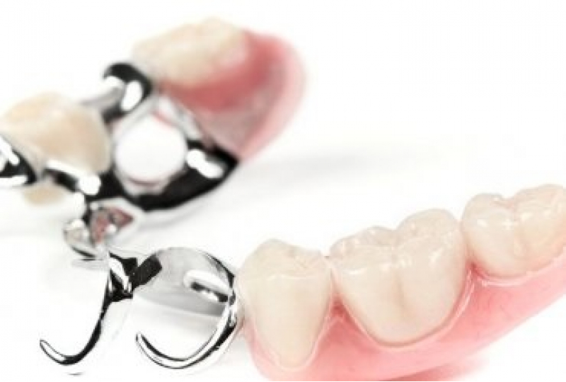 Бюгельное протезирование