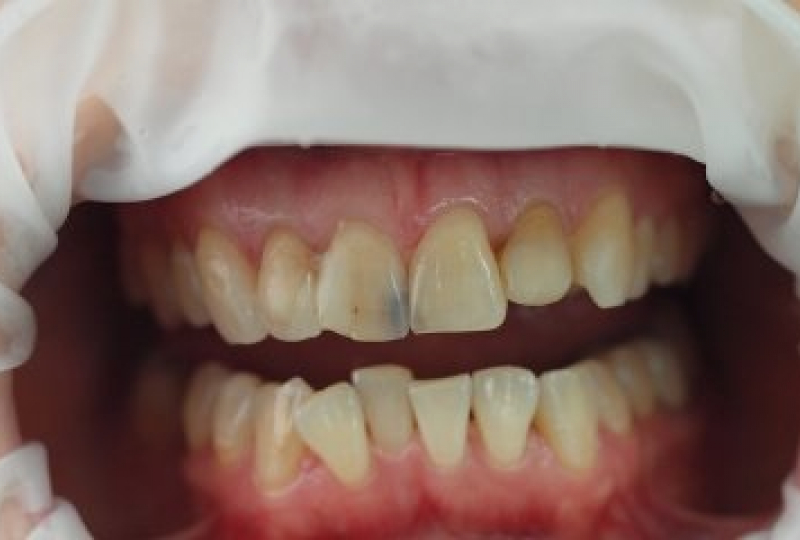 Установка коронок из безметалловой керамики Emax