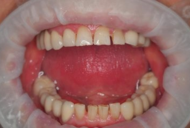 Дентальные импланты и ортопедическиеконструкции