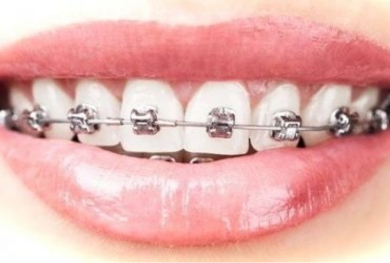 Брекеты