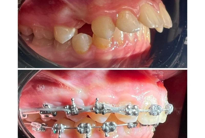 Ортодонтическое лечение