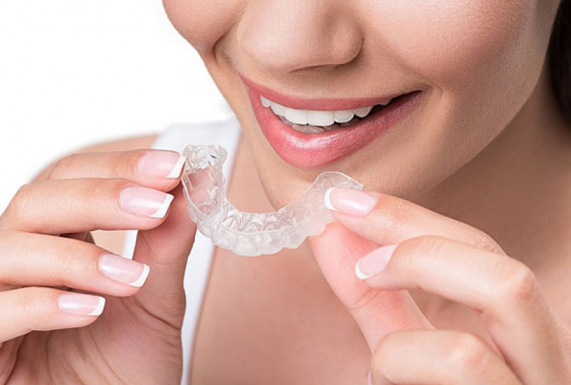 Каппы для выравнивания зубов