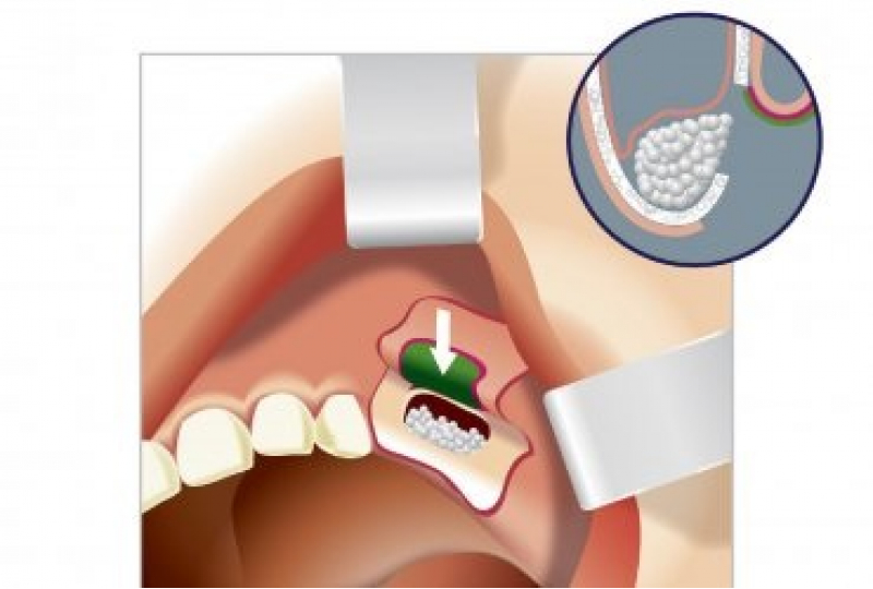 Синус-лифтинг