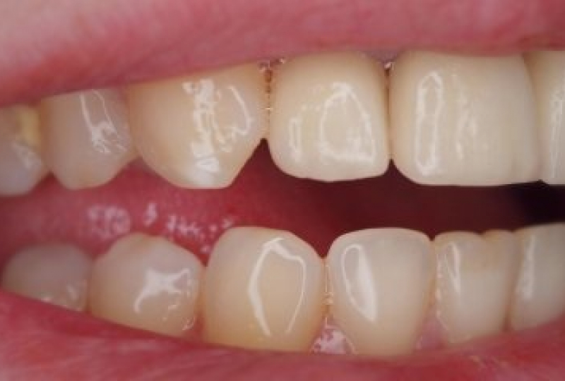 Замена старых ортопедических конструкций