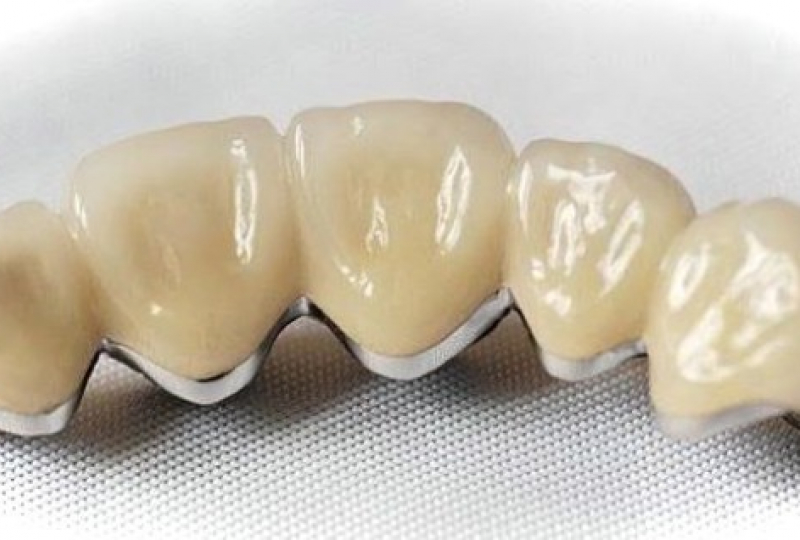 Металлокерамика