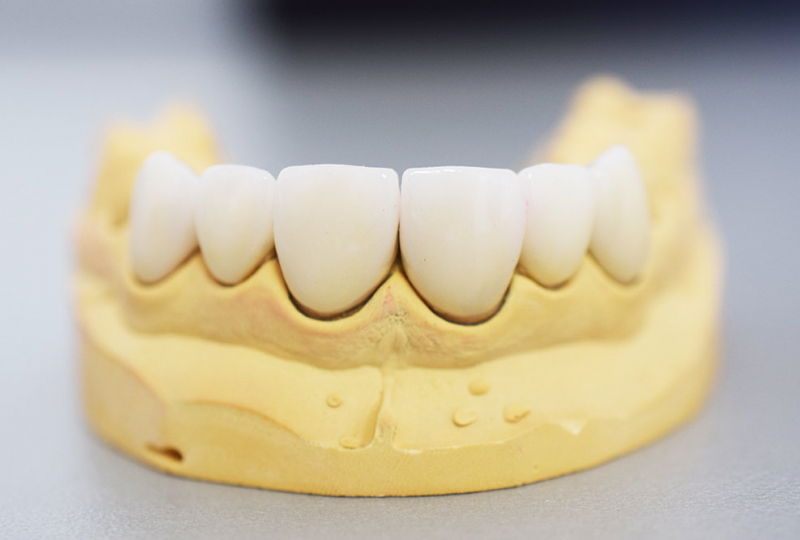 Установка виниров