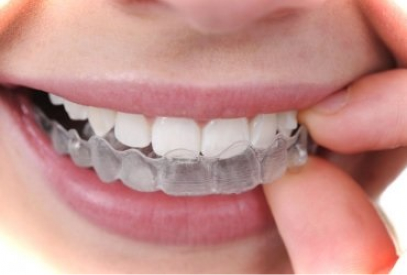 Выравнивание зубов