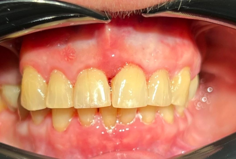 Ортодонтическое лечение