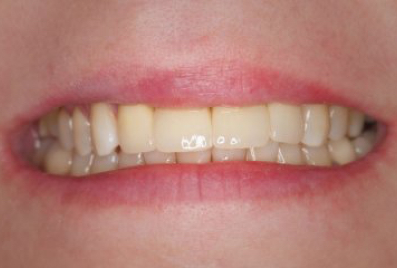 Безметалловые коронки Emax и виниры