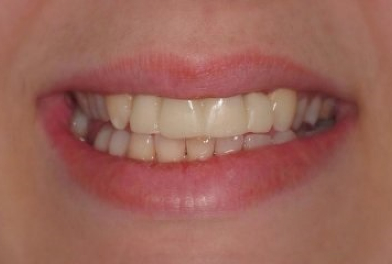 Замена старых ортопедических конструкций