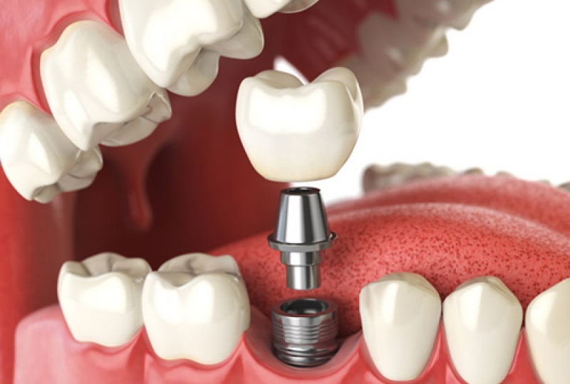 Гигиена полости рта