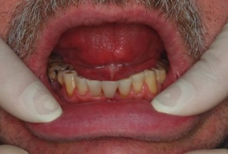 Установка искусственного зуба на стекловолокне