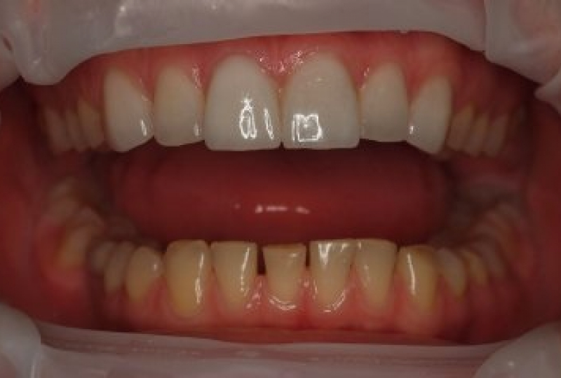 Устранение промежутков между нижними передними зубами